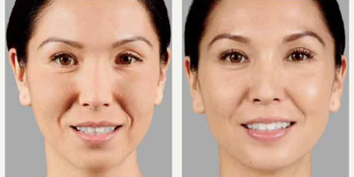 Woman treated with Voluma - Woman treated with Juvederm Voluma (4 ml) injected into the cheek area.