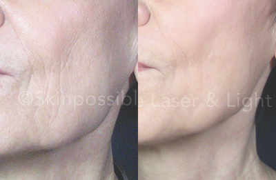 65-74 year old woman treated with TotalFX - We did a Total FX to this client to reduce her wrinkles
