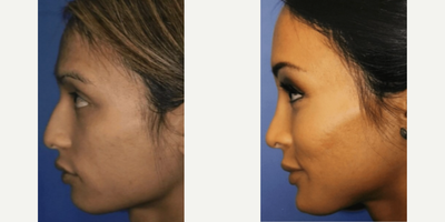 Transgender woman treated with Rhinoplasty - Patient treated with Rhinoplasty