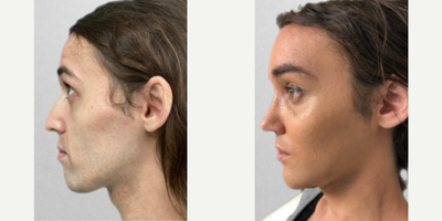 Transgender woman treated with Rhinoplasty - Patient treated with Rhinoplasty