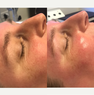 45-54 year old woman immediate difference after dermaplane procedure - Immediate smoothing effect of skin with added hydration and exfoliation of excess dead skin cells. With maintenance of treatments the patient will see prolonged effect of brighter, healthier skin with less pigmentation and fine lines.