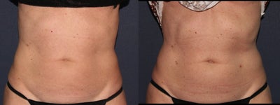55 yo Female ThermiTight for Abdominal Skin Laxity - 55 yo Female One ThermiTight procedure 3 months later for abdominal skin laxity.