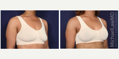 35-44 year old woman treated with Strattice - Augmentation mastopexy with Strattice. Follow-up photo taken 1 month after the procedure.