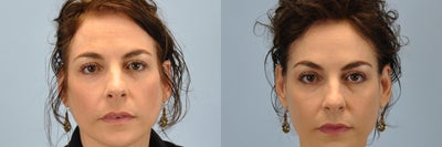 42 Year old Female treated with Voluma - This 42 year old was treated with Voluma filler in her cheeks.