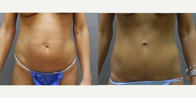 35-44 year old woman treated with Tummy Tuck - This patient had a tummy tuck with liposuction to the abdomen and hiprolls.