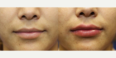 Woman treated with Injectable Fillers - Woman treated with Injectable Fillers using Juvederm for a natural and plumper-looking lips.