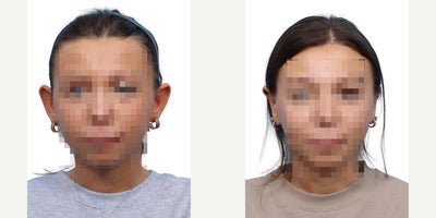 19 year old woman treated with Ear Surgery - This 19-year-old female was unhappy by the appearance of prominent ears. She underwent otoplasty, creating a more balanced and natural ear appearance.