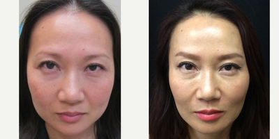 35-44 year old woman treated with Kybella - Combining 2 vials of Kybella with 50 units botox in the masseters to create a slimmer jaw line (V-line). Focusing more on the shape of the face is a more advanced approach to facial aesthetics. The goal is to re-create the heart shape oval of youth by reducing volume where it's full and adding filler where it's deficient. Like art - it's best to do things in stages and focus on one area at a time.