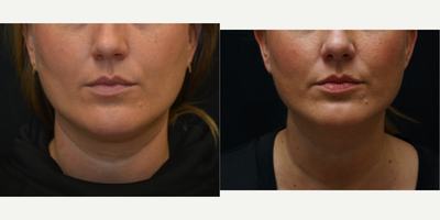 38 - year old Woman treated with 1 vial of Kybella - 38 - year old Woman treated with 1 vial of Kybella