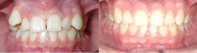 17 or under year old woman treated with Damon Braces - Distal Jet to make space for the canines and Damon braces to finish up alignment.
