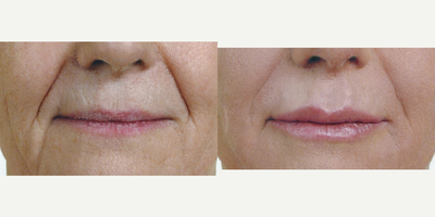 55-64 year old woman treated with Radiesse - Patient had Radiesse injected to the nasal folds to fill and soften the lines around the mouth.&nbsp;