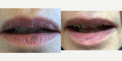 Venous Lake treated with Excel V laser - This patient has a common venous lake, a blood vessel pooling of venous blood thats benign in their lower lip. It failed treatment with the V-beam laser and needed a deeper laser, which we have, called the Excel V laser. This result is after one treatment 1000% resolution, no scarring.
