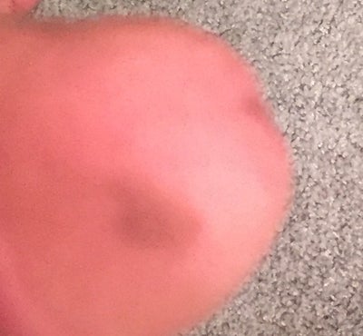 Birthmark On Penis 49