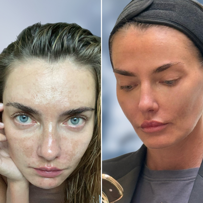 25-34 year old woman treated with PRF Treatment, Exo-Xom, Vampire Facial - Check out the incredible transformation of our patient after just three treatments with exosomes and PRF.
