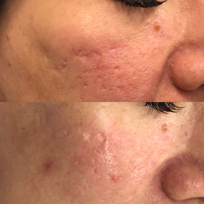 25-34 year old woman treated with Vivace - Vivace