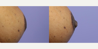 44 year old woman treated with Nipple Surgery - 44 year old woman treated with Nipple Surgery - Inversion Correction