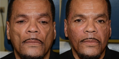 45-54 year old man treated with Cheek Lift - Before and after filler injections for facial rejuvenation and contouring (liquid face lift)