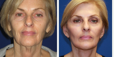 65-74 year old woman treated with CO2 Laser, face and neck lift - My patient was complaining of looking tired, she felt much younger than she looked and is a beautiful woman. She underwent a face and neck lift with laser resurfacing, all without general anesthesia. The laser resurfacing treats the lines around her lips, cheeks and eyes, while evening skin tone and softening sun spots and age spots.