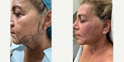 Woman treated with Chin Liposuction, Facial Fat Transfer, MiXto Laser, Fractional Laser, Laser Resurfacing, Liposculpture - Ten days after a facelift, liposuction of the neck, fat grafting & today Mixto Fractional Laser resurfacing of the face & facelift scars.