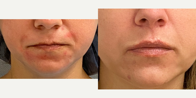 35-44 year old woman treated with Lip Lift, Lip Implants - 37 yo s/p lip lift an permalip lip implants under local anesthesia with sedation in our on site AAAA certified operating suite.