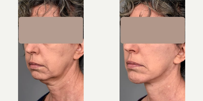 Woman treated with Facelift - Woman treated with Facelift
