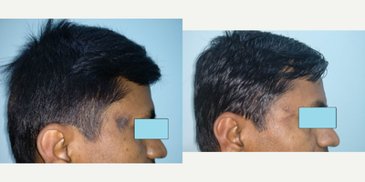 35-44 year old man treated with Scar Removal - childhood burns scar over the temple region treated by scar revision surgery
