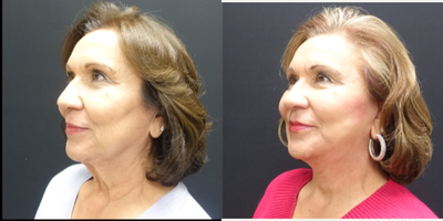 65-74 year old woman treated with Facelift - The patient underwent a high lateral SMAS face and necklift. The SMAS elevation supports the facelift so that their is minimal tension on the skin and enhance the possible longevity of the face and necklift. Along with the face and necklift she also had fat transfer to the face. Fat was transferred tough out the face and temples to restore the volume she has lost over time as we age. The combination of tightening and filling of the face gives her a much more youthful but natural appearance. This pictures show her two month result.