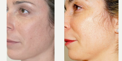 45-54 year old woman treated with DefenAge - 45-54 year old woman treated with DefenAge