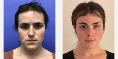 Patient treated with Facial Feminization Surgery, Transgender Facial Feminization Surgery, Cheek Augmentation, Rhinoplasty, Sept - 25 to 34 year-old female patient is 6 months post-op from Facial Feminization surgery. Her procedures included: Forehead Lift, Hairline Lowering, Orbital Bony Contouring, Septorhinoplasty (open) with Cartilage Grafts and Weirs, Cheek Implants (small combined), 2 cc Voluma to Medial Cheeks, Chin Reduction and Contour, Thyroid Cartilage Shave, Intranasal Lip Lift with Fat Augmentation, Soft Tissue to Nasolabial Folds and 300 Micrografts to the Fronto Temporal Recessions.
