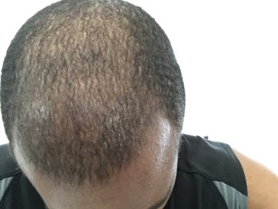 Is it safe to undergo a hair transplant with untreated Seborrheic  dermatitis? What are the pros and cons of such a step? | by Dr.John Watts  HairSurgeon | Aug, 2023 | Medium