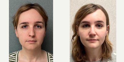 25-34 year old woman treated with Forehead Reduction, Brow Lift, Brow Bone Reduction, Facial Feminization Surgery, Rhinoplasty,  - This is a young lady who underwent forehead feminization, septorhinoplasty, cheek augmentation via fat grafting, and chin reduction.