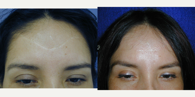 25-34 year old woman treated with Scar Removal - 34 year old female underwent scar revision surgery under local anesthesia.