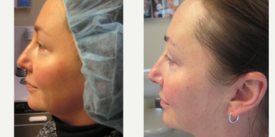 45-54 year old woman treated with ResurFX - 57 year old female underwent ResurFx sessions.