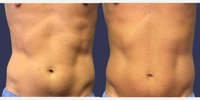 25-34 year old man treated with truSculpt flex - Before and After 6 treatments of Abs/Flanks