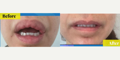45-54 year old woman treated with Silicone Injection Removal - This patient came into our office presenting with overfilled, lumpy-looking silicone injections in her lips that were causing her discomfort and pain. The doctor surgically removed the silicone to maintain the patient's natural lip shape.