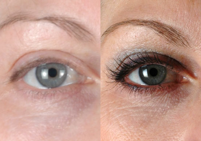 Latisse  - 
	Patients Eyelashes were short and could not be seen even with an eyelash curler. She loves how Latisse has increased the length and volume of her eyelashes.
