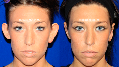 Ear Reconstruction: Microtia - 	Ear Reconstruction: Microtia