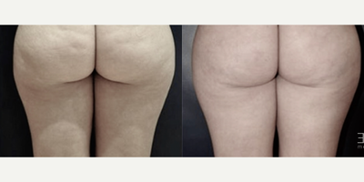 45-54 year old woman treated with Cellfina - The Cellfina System treats the primary structural cause of cellulitethe connective bands woven throughout fat in the thighs and buttocks. These tight bands pull down the skin, creating the puckering you see on the surface of the skin. Similar to a rubber band under tension, once released, the treated skin bounces back to smooth itself out in as little as three days.