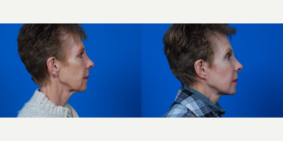 55-64 year old woman treated with Facelift, CO2 Laser - Bilateral facial rhytidectomy. Bilateral facial microfat graft placement bilateral malar and cheek area, bilateral temporal area, and bilateral nasolabial fold area. Perioral Co2.
