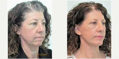 45+ year old woman treated with Facelift, Chin Implant, Upper Eyelid Surgery, Lower Eye Laser Resurfacing - This woman presented with the concerns of heavy and droopy eyes, along with sagging of her lower face and neck. Examination revealed excessive hooding over her eyes as well as lax and wrinkled skin underneath her eyes. Her lower face aging was in part due to a deficient chin and the natural effects of gravity and age which presented as jowling and a turkey/chicken neck.The plan we decided on was a lower facelift and necklift along with a silicone chin implant to improve her profile and jawbone angles. We also decided on an upper blepharoplasty for her eyes to address the hooding, and fractional CO2 lasering under her eyes for the wrinkled/worn out skin.All treatments were performed in the same sitting under local anesthesia in our office. Oral sedation was given with xanax as no IV or general anesthesia was necessary. Total surgical time to complete all procedures was 3 (three) hours. Most sutures were removed on day 6, and the remainder at day 12. She was able to return to full physical activity 14 days after procedure with minimal limitations.Her results demonstrate significant improvement in her eyes, as she can now see her eyelids and apply makeup. The skin under her eyes is significantly tighter compared to pre-laser comparison. Her neck and jawline are much more defined with improved sharper angles while still keeping a natural appearance.