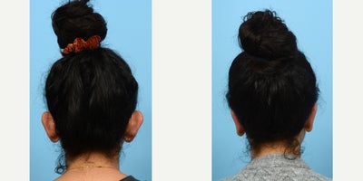18-24 year old woman treated with Earfold, Ear Surgery - Having big ears is a common concern with a simple solution -- otoplasty, or ear surgery. Often times, overly projected ears are misconstrued as being disproportionately sized for a person's head. In truth, the issue lies in the way the ear is shaped, and by creating a new helical fold or adjusting the placement of the conchal bowl, the ears can be perceived to be much smaller. This was the case for this 24-year-old patient, who is thrilled with the outcome of her ear surgery with Dr. Wise.