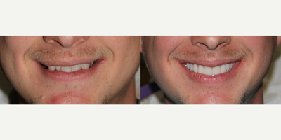 All-on-4 Dental Implants - All-on-4 Dental Implants