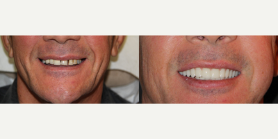 All-on-4 Dental Implants - All-on-4 Dental Implants