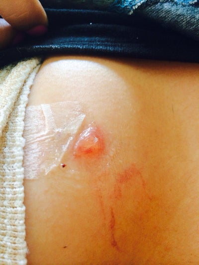 Breast reconstruction blisters on breast