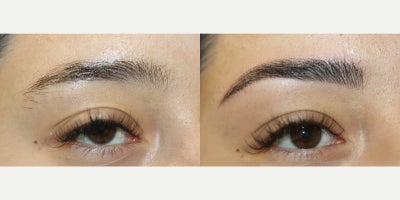 25-34 year old woman treated with Permanent Makeup, Microblading - Microblading is a precision-based form of cosmetic tattooing designed to enhance and restore natural brow shape. Each treatment is performed by Ruth Swissa, CMM, a leading expert in medical micropigmentation.Using a sterile, single-use microblade, ultra-fine pigment is deposited into the superficial dermis to create realistic, hair-like strokes that blend seamlessly with existing brow hair. Each procedure includes a detailed facial analysis and custom brow mapping to ensure symmetry, balance, and a tailored result.Ideal for patients with thinning brows, asymmetry, or hair loss, microblading delivers soft, natural-looking enhancement with results that continue to refine as the pigment settles. *A follow-up session is recommended to perfect the final outcome.