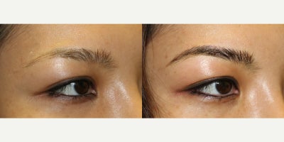 35-44 year old woman treated with Microblading, Permanent Makeup - Microblading is a precision-based form of cosmetic tattooing designed to enhance and restore natural brow shape. Each treatment is performed by Ruth Swissa, CMM, a leading expert in medical micropigmentation.Using a sterile, single-use microblade, ultra-fine pigment is deposited into the superficial dermis to create realistic, hair-like strokes that blend seamlessly with existing brow hair. Each procedure includes a detailed facial analysis and custom brow mapping to ensure symmetry, balance, and a tailored result.Ideal for patients with thinning brows, asymmetry, or hair loss, microblading delivers soft, natural-looking enhancement with results that continue to refine as the pigment settles. *A follow-up session is recommended to perfect the final outcome.