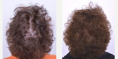 55-64 year old woman treated with female pattern hair loss with Low-level laser therapy - Photos show patient in her early 60s and suffering from Androgenetic Alopecia. Photos shown are before treatment and 1 year into her custom fit laser program. LLLT program consists of using LLLT every other day for 30 minutes.