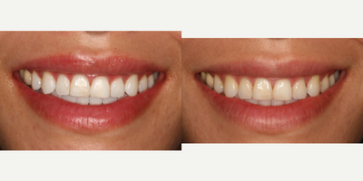 25-34 year old woman treated with Zoom Whitening - This patient desired whiter teeth. Zoom Teeth Whitening was used to achieve brighter, whiter teeth. Patient was very happy with results.