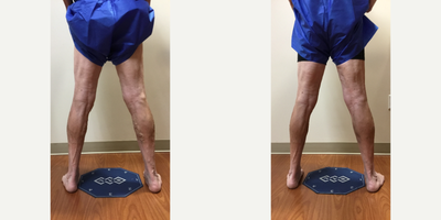75 and up year old man treated with EVLT, Sclerotherapy - EVLT and ultrasound guided sclerotherapy treatments performed for patients varicose veins.