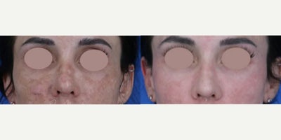 Woman treated with Laser Resurfacing, Skin Rejuvenation - Gender: FemaleEthnicity: CaucasianAge: 26 - 30Procedure: Hyperpigmentation, Melasma